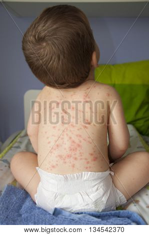 A baby boy showing his back with chicken pox