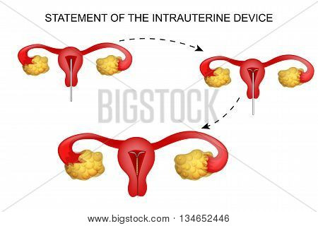 illustration of the process of making intrauterine devices