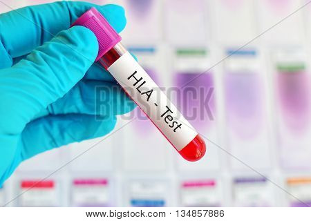 Blood sample for HLA (Human Leukocyte Antigen) test