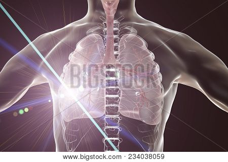Lung Cancer Treatment And Prevention Concept, 3d Illustration