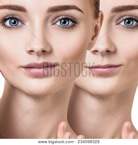 Beautiful Lips Of Young Woman. Before And After Lips Filler Injections. Fillers Concept.