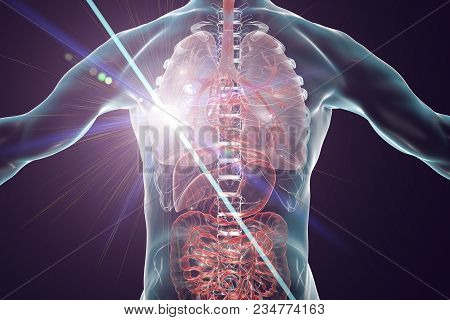 Lung Cancer Treatment And Prevention Concept, 3d Illustration