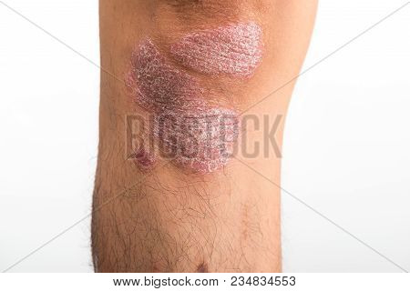 Psoriasis That Knee On White Background Studio Shot