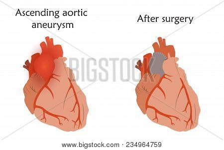 Ascending Aortic Aneurysm Before And After Repair. Tube Graft And Damaged Heart Muscle. Anatomy Flat