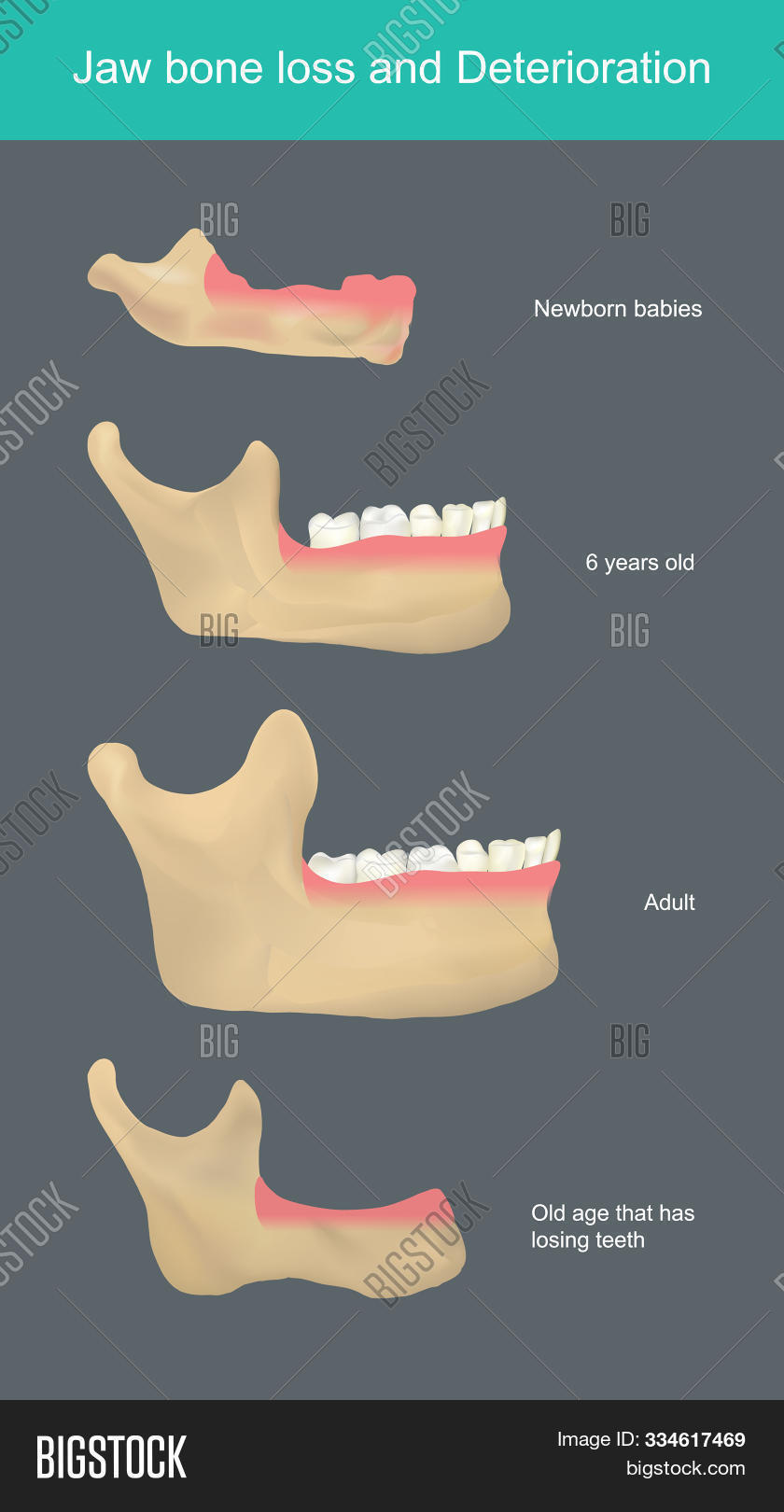 Jaw Bone Loss Image & Photo (Free Trial) Bigstock