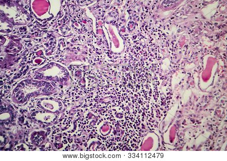 Chronic Nephritis, Light Micrograph, Photo Under Microscope