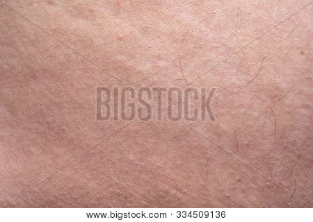Photo Of Humans Skin With The Stretch Marks, Closeup Photo