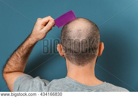 A Man Combs His Bald Head With A Comb. Blue Background. Rear View. The Concept Of Alopecia And Baldn