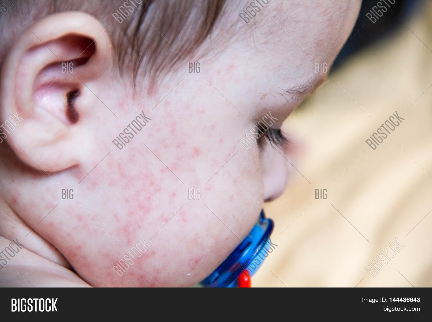 Baby Dermatitis Image & Photo (Free Trial) Bigstock