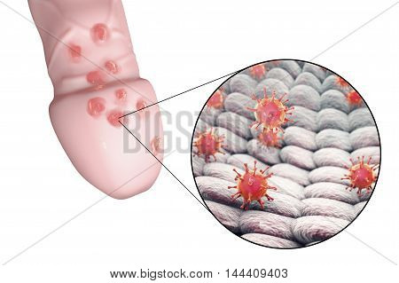 Genital herpes lesions and close-up view of herpes simplex viruses attaching to human cells, 3D illustration