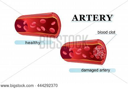 Blood Clot Thrombus Medical Poster Made From Red Cells Linked By Fibrin Strands. Vector Illustration