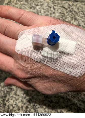 A Cannula Is Stuck In A Vein In One Hand.