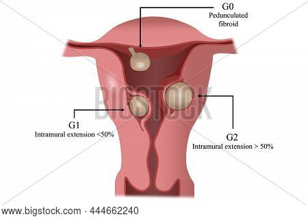 Society For Gynaecological Endoscopy (esge) Classification Of Uterine Fibroids (leiomyomas)