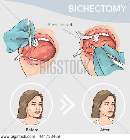 Buccal Fat Pad Removal  Before And After Vector Illustration