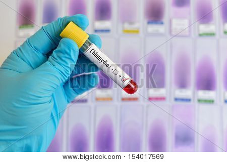 Blood sample positive with Chlamydia trachomatis bacteria