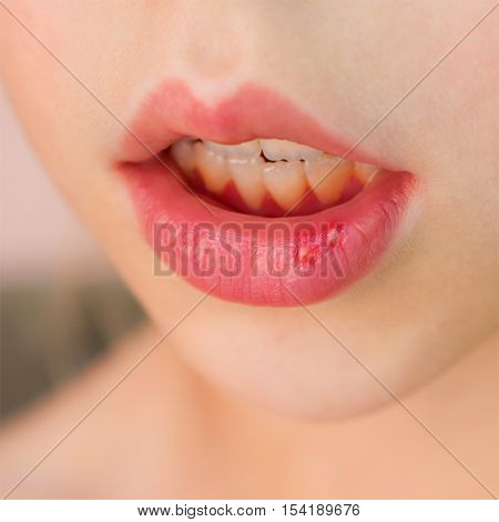 Closeup stomatitis on the lip in child