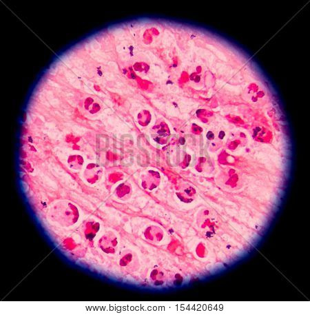 Gram Stain Showing Blue Cells Gram Positive In Single,in Pair,in Cluster Intracellular On Red White