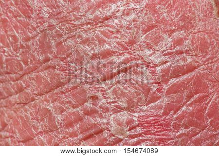 Psoriasis skin. Psoriasis is an autoimmune disease that affects the skin cause skin inflammation red and scaly.