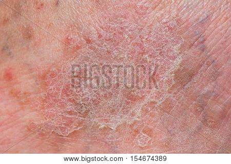 Psoriasis skin. Psoriasis is an autoimmune disease that affects the skin cause skin inflammation red and scaly.