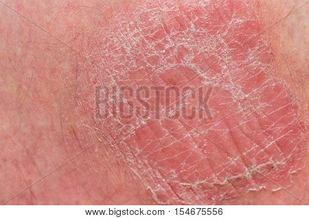 Psoriasis skin. Psoriasis is an autoimmune disease that affects the skin cause skin inflammation red and scaly.