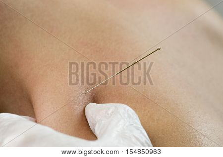 Closeup of a needle and hands of physiotherapist doing a dry needling.