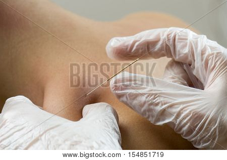 Closeup of a needle and hands of physiotherapist doing a dry needling.