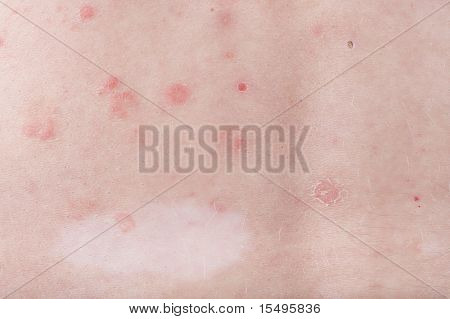 Pleť s lupénkou a Vitiligo léze