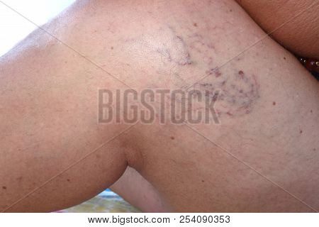 Swollen Blood Vessels On Female Mature Legs