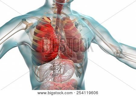 Pneumonia Medical Concept, 3d Illustration Showing Lobar Pneumonia Of The Right Lung