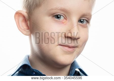 Herpes Is An Eye Disease On The Face Of A Child. Little Boy With Conjunctivitis. Rash Near The Eye. 