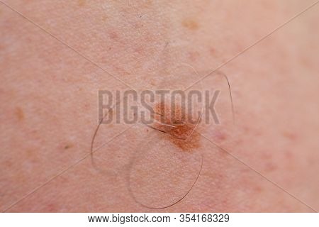 Close Up Picture Of Dangerous Brown Nevus On Human Skin - Melanoma