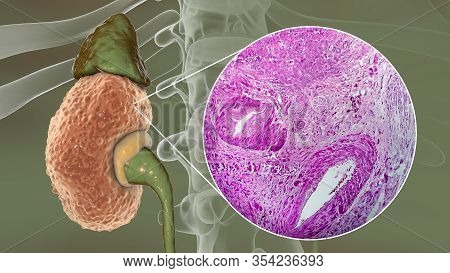 Chronic Glomerulonephritis, 3d Illustration Showing Pale Contracted Coarsely Granular Kidneys And Li