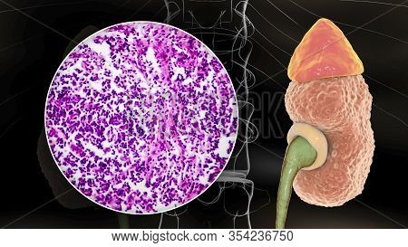 Chronic Glomerulonephritis, 3d Illustration Showing Pale Contracted Coarsely Granular Kidneys And Li