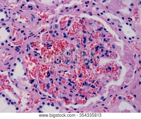 Diseased Kidney Showing Glomerular And Peritubular Congestion. The Glomerular Capillaries Appear Ver