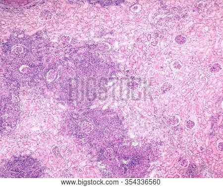 Low Magnification Micrograph Showing A Kidney Affected By A Chronic Pyelonephritis. Very Large Nodul