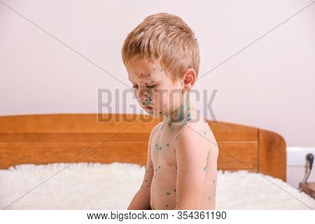 Young Toddler,boy With Chickenpox. Sick Child With Chickenpox. Varicella Virus Or Chickenpox Bubble