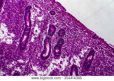 Endometrial Hyperplasia, Light Micrograph, Photo Under Microscope