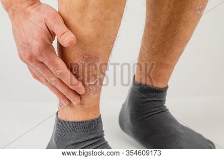 Application Of Therapeutic Ointment For Allergic Rashes On The Leg. Treatment Of Psoriasis, Cosmetic