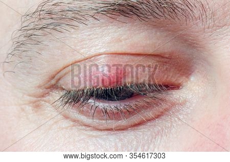 Chalazion On The Eyelid Of A Man Close-up.