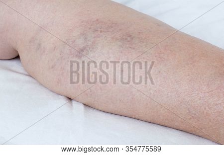 Varicose Veins On The Legs Of A Person, Thrombophlebitis, Anatomical