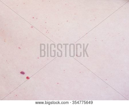 Two Red Moles On The Patient S Skin, Hemangioma, Angioneuromas, Copy Space