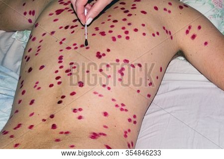 A Female Hand Disinfectes Chicken Pox Papules On The Back Of A Young Man.