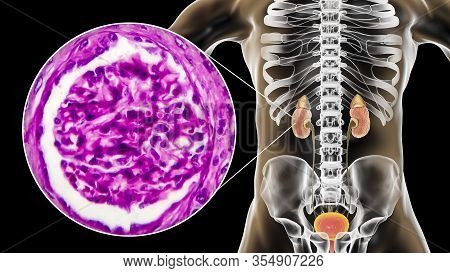 Chronic Glomerulonephritis, 3d Illustration Showing Pale Contracted Coarsely Granular Kidneys And Li