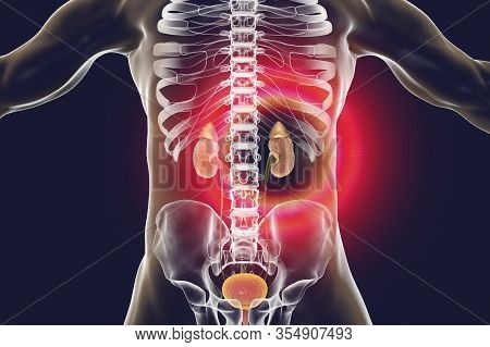 Chronic Glomerulonephritis, Gross Pathology, Scientifically Accurate 3d Illustration Showing Pale Co
