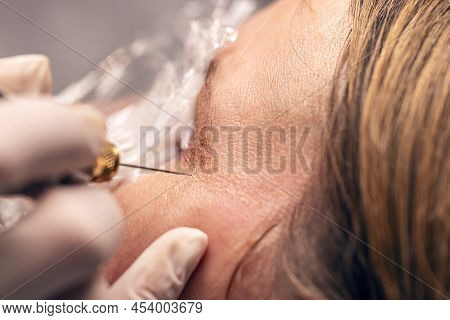 Women Eyelid Lifting, Fibroblast Procedure, Luxury Plasma Liner Treatment
