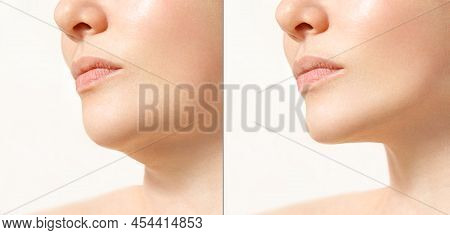 Female Double Chin Before And After Correction. Correction Of The Chin Shape Liposuction Of The Neck