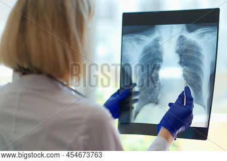 Close-up Of Doctor Pointing At Damaged Area On Lung X Ray. Radiologist Or Pulmonologist Making Diagn