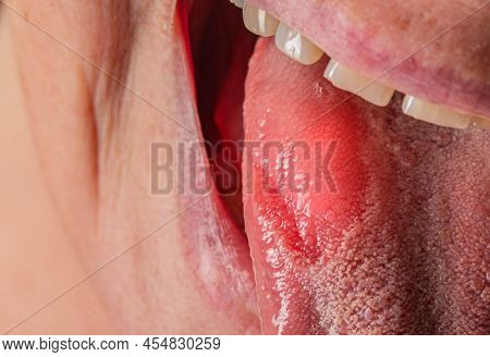 Inflammatory Disease In The Tongue. Red Spot, Glossitis. Hygiene Of The Tongue