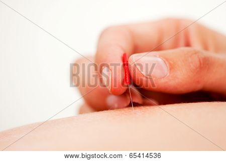 Macro detail of a acupuncture needle inserted on the back being stimulated