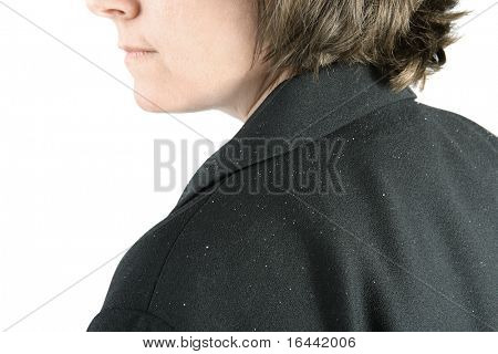 Kobiety ramię z łupieżem